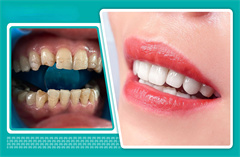 四环素牙的牙齿美容方法有哪些？