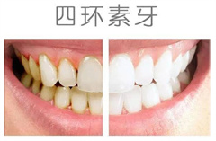 四环素牙真的能变白吗？