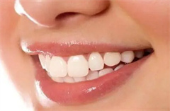 盘点：四环素牙的美白法宝