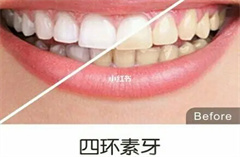 四环素牙也能美白吗？