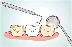 四环素牙如何美白