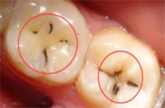 牙齿上出现黑点是什么原因？
