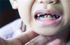 2岁的小孩牙齿又黑又黄是什么原因？