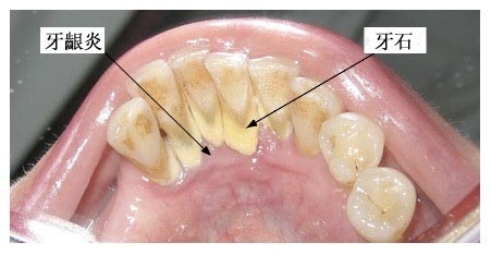  Geramage聚合瓷贴面修复体用于活髓前牙美容对牙周相关指标的影响