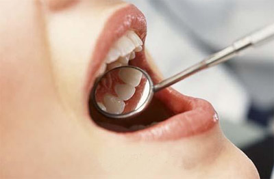 洗牙,定期,美白,预防龋齿