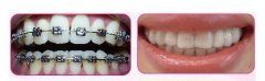 <b>成人矫正牙齿多少钱？</b>