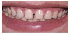 成人牙齿稀疏怎么快速修复？
