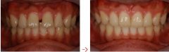 武汉牙齿矫正有哪些方式？