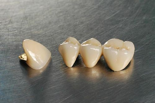 钛合金烤瓷牙价格