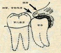 智齿发炎怎么办？