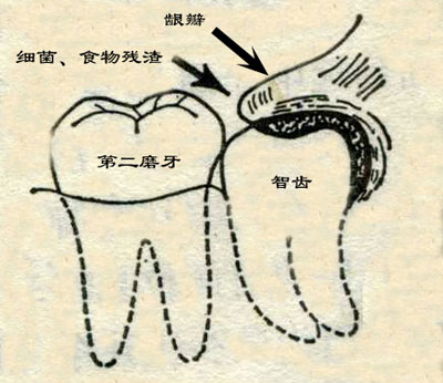 智齿发炎怎么办