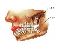 <b>智齿一定要拔吗？</b>