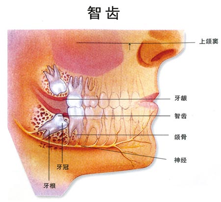 什么是智齿