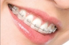 牙齿正畸有哪些好处？