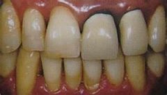牙龈发黑是烤瓷牙引起的吗？