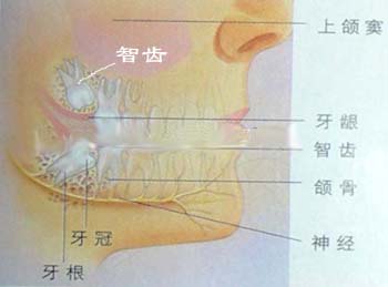 智齿磨口腔可以拔吗