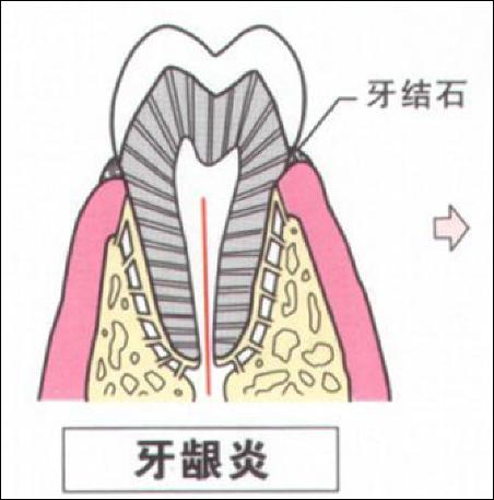 儿童牙龈炎的类型
