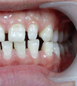 牙齿稀疏治疗前