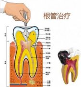 根管治疗对大脑有影响吗？