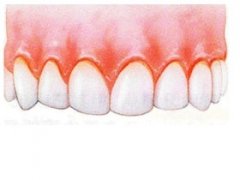 牙龈出血是怎么回事？需要治疗吗？