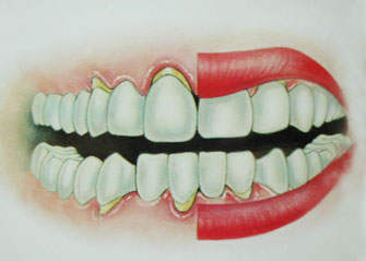 牙缺失后牙槽骨萎缩