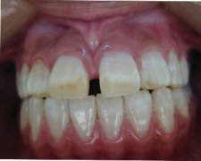 前牙稀疏可以矫正吗？
