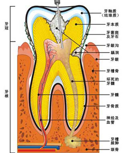 根管治疗成功率高不高