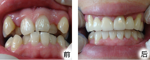 13岁孩子快速矫正牙齿