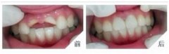 门牙断了一半一定要做烤瓷牙么