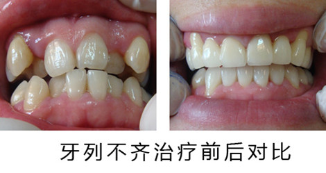 戴牙套是什么原理_什么是牙套脸图解(3)