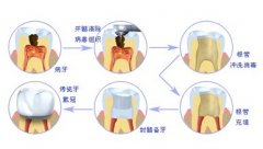 根管治疗后需要牙套吗？