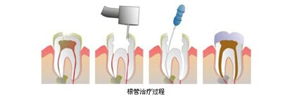 武汉根管治疗价格