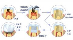 根管治疗后最好做牙套保护起来