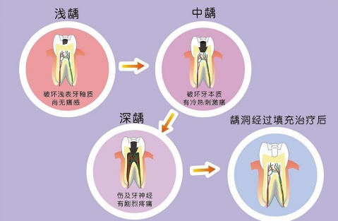 经期补牙可以吗