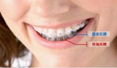 儿童牙齿矫正可以戴隐形矫正器吗？