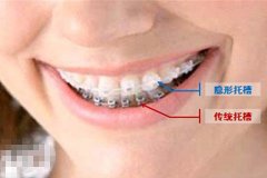 牙齿矫正有几种方法？
