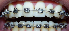 牙齿矫正器的种类有哪些