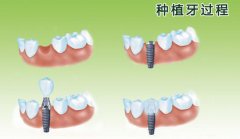 牙缺失多久能够采取即刻种植？