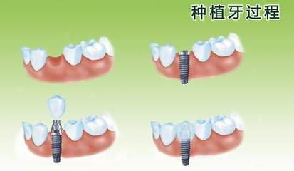 武汉种植牙过程