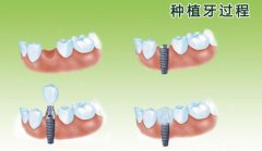 种植牙价格表