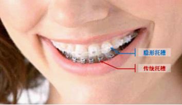 爱齿尔口腔矫正方式对比