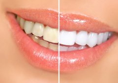 喷砂洁牙真的可以美白牙齿吗？