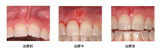 爱齿尔口腔治疗牙周病