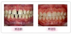 牙齿稀疏正畸价格