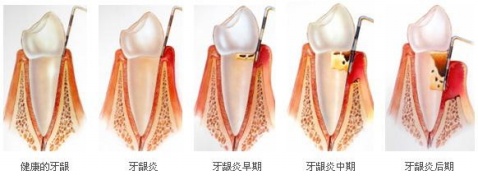 爱齿尔口腔治疗牙龈炎