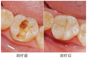 爱齿尔治疗儿童虫牙