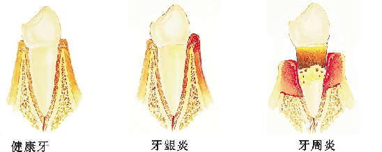 武汉爱齿尔口腔牙周炎治疗