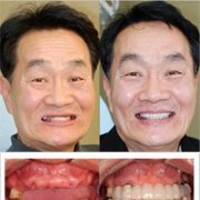牙齿缺失装什么假牙好？