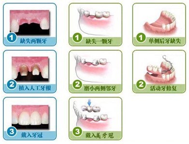 爱齿尔口腔缺牙镶牙修复