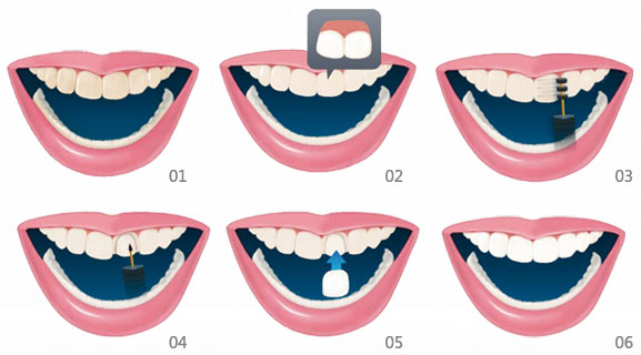 爱齿尔口腔瓷贴面的过程
